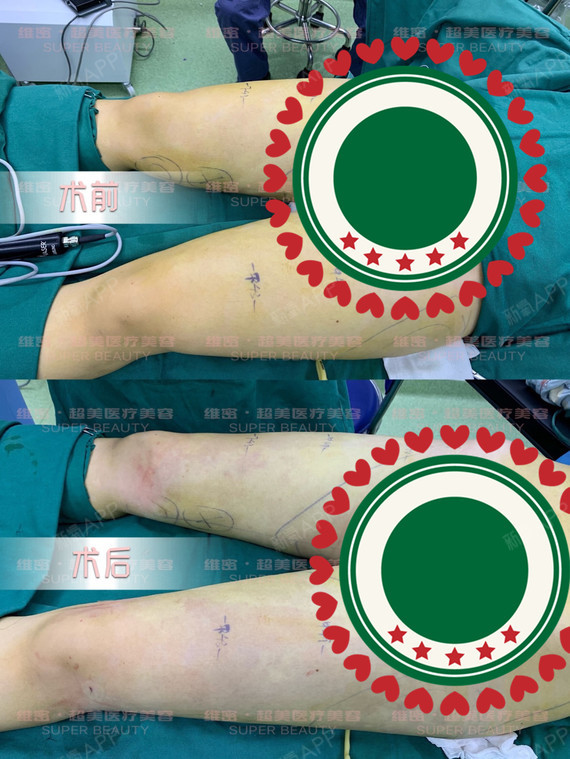 腿上的脂肪堆积过多不仅会让大腿粗壮,还会让人看上去_圈子-新氧美容