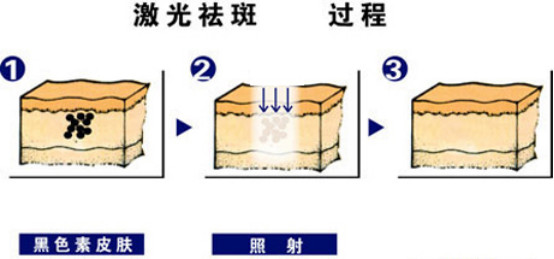 怎样消除黑眼圈 新氧美容整形