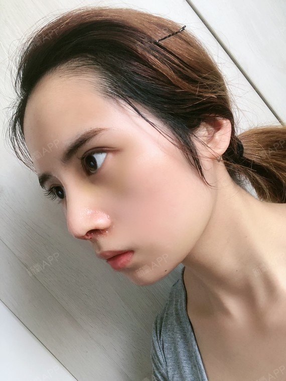 耳软骨复合隆鼻好不好_效果图_氧气zaa1086耳软骨复合隆鼻术后第7天