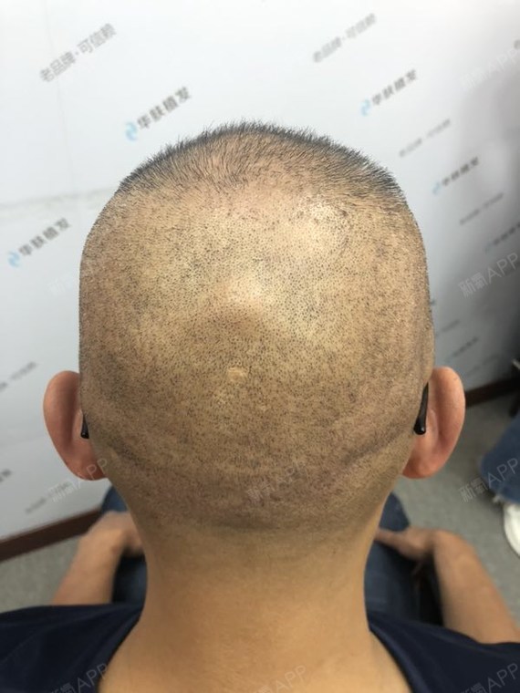 这是我植发后2个月到医院复查拍的照片,分享给大家看_圈子-新氧美容