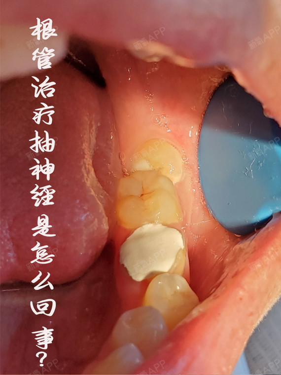 抽牙神经是不是很恐怖?咋还这么贵?