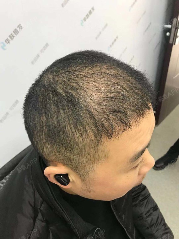 这是我植发后5个月的效果,明显比3个月的时候要好很_圈子-新氧美容整