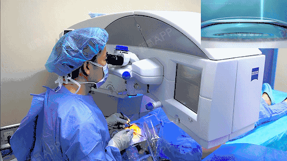 近视手术超全攻略!眼科院长也给自己做近视激光(下)