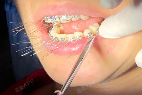 选托槽矫正,还得知道自锁和普通的区别!