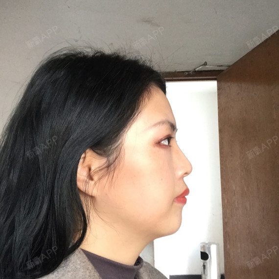 已经过去几个月拉99,脸部左侧因为一直咀嚼,咬肌有点_圈子-新氧美容