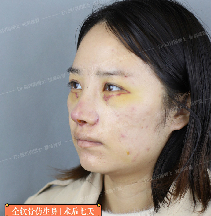 [:13]"binder综合症"又称先天性中面部凹_圈子-新氧美容整形