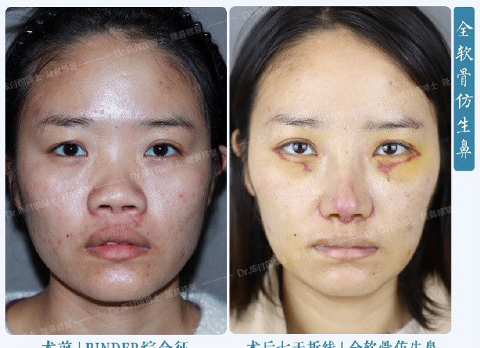 [:13]"binder综合症"又称先天性中面部凹_圈子-新氧美容整形