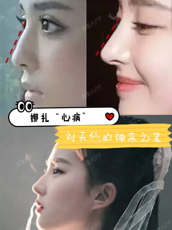 首页 此页面仅支持预览 Avatar 杨健 106篇日记 娜扎直言不好看 女娲好任性 古力娜扎自言觉得自己的鼻子不够精致 因此不够自信 听听这是人话嘛 但同时我们也都看到了 她的鼻子部分 显男相的驼峰模糊不见 同时鼻头也变高 整体由颇具