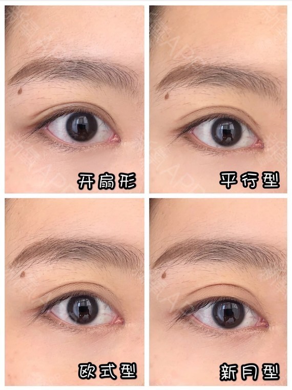 做双眼皮最重要是什么