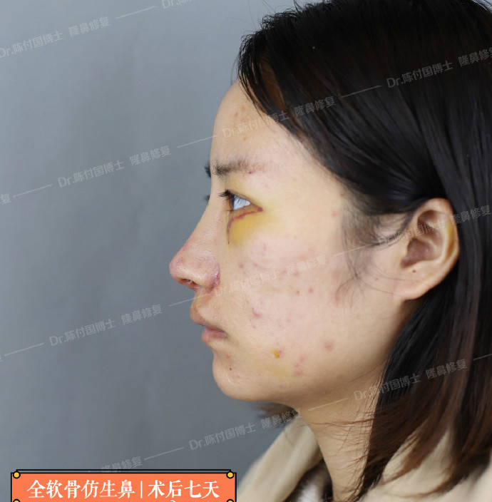 [:13]"binder综合症"又称先天性中面部凹_圈子-新氧美容整形