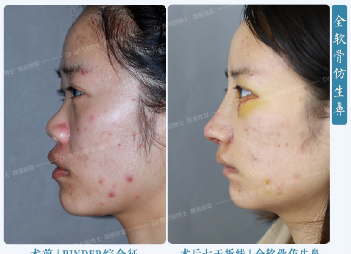 [:13]"binder综合症"又称先天性中面部凹_圈子-新氧美容整形