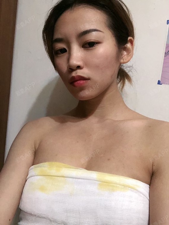 【贵阳美贝尔--自体脂肪丰胸】今天来给姐妹说下我做_圈子-新氧美容
