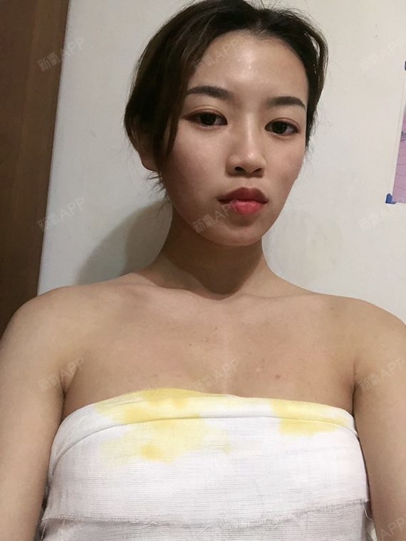 【贵阳美贝尔--自体脂肪丰胸】今天来给姐妹说下我做_圈子-新氧美容