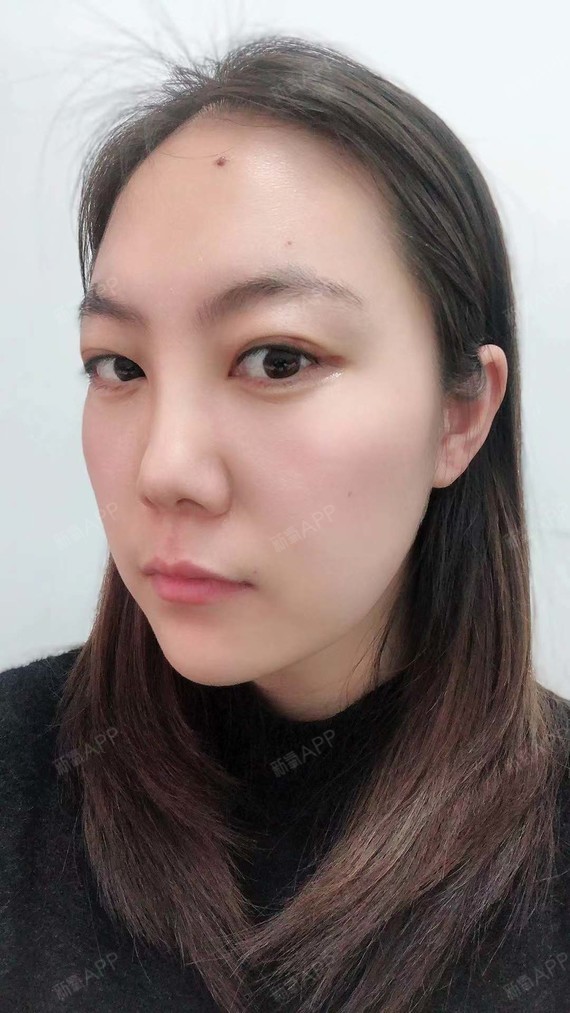 北京上眼睑去脂好不好_效果图_氧气rzne992上眼睑去脂术后第9天_新氧