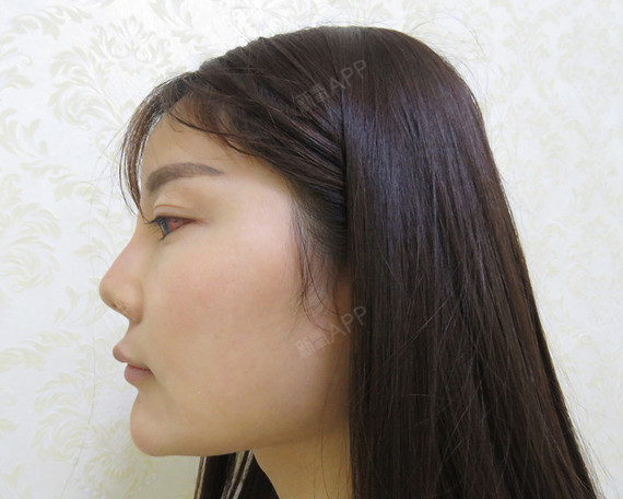 武汉手术延长鼻小柱好不好_效果图_悲喜自渡g手术延长鼻小柱术后第6天