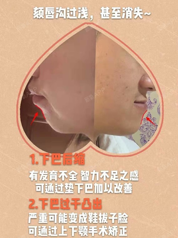 面部下庭美学标准:鼻唇角&颏唇沟 92鼻唇角鼻唇角就_圈子-新氧美容