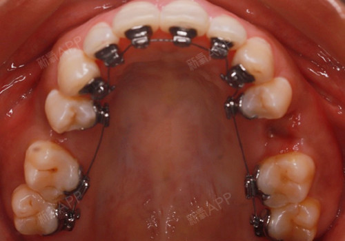 都是钢丝托槽,舌侧和传统矫正有何不同?
