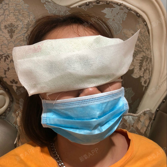 到医院做冰敷,眼睛目前还是很肿.