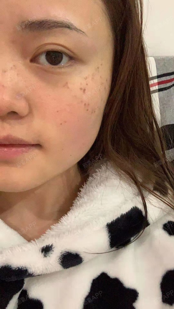 激光点痣好不好_效果图_深圳千羽医疗美容医院激光点痣术后第18天