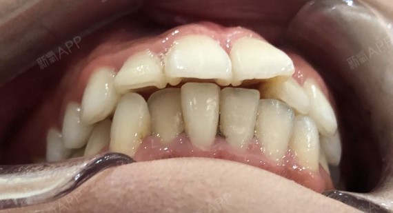 之前一直顾虑要不要戴牙套,但是对于那种大钢牙心里一_圈子-新氧美容