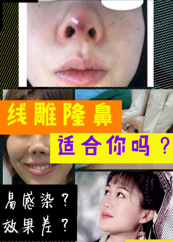 07线雕隆鼻,就是将蛋白线注入鼻部,通过线的牵引提拉_圈子-新氧美容