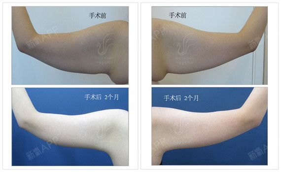 韩国身体赘皮整形是 流水式 切除松弛下垂皮肉 朴润 圈子 新氧美容整形
