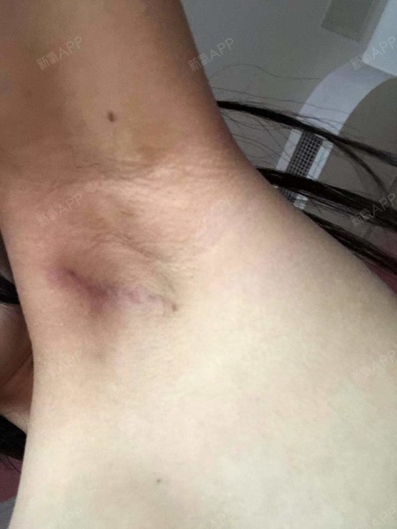 之前不给大家拍腋下切口,第一是忘记了,第二是没有去_圈子-新氧美容