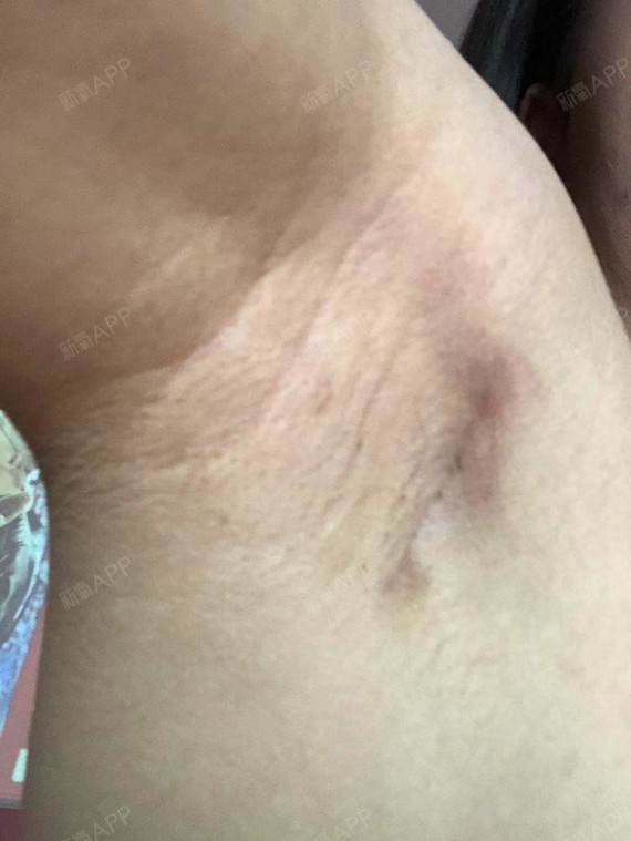 之前不给大家拍腋下切口,第一是忘记了,第二是没有去_圈子-新氧美容