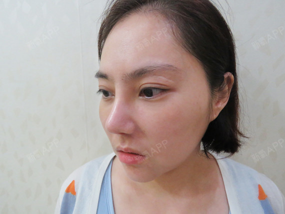 武汉曼特波隆鼻好不好_效果图_呢个了钱啊曼特波隆鼻术后第7天_新氧