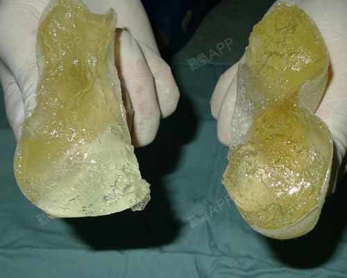 假体隆胸7大风险,如何规避?