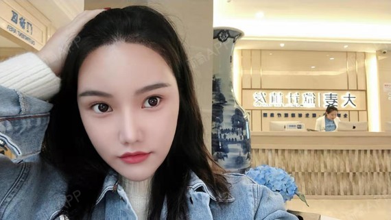 【大麦微针植发#种植发际线#术后3天】今天过来清洗_圈子-新氧美容