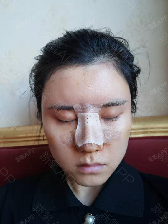 前几天医生会在有切口的鼻孔填塞一块小纱布,目的是压_圈子-新氧美容