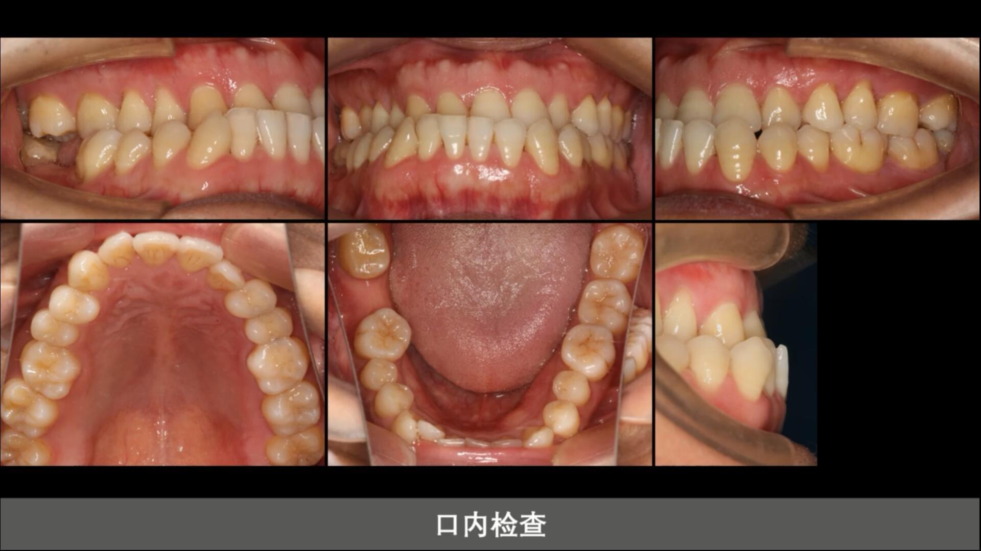 請問我這個是骨性地包天還是牙性地包天