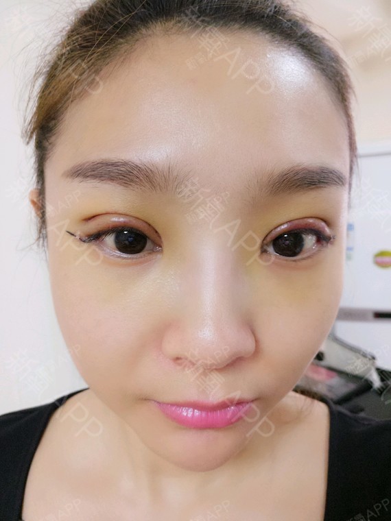今天已经是开眼角第四天了~~~我觉得我的肿胀已经明_圈子-新氧美容