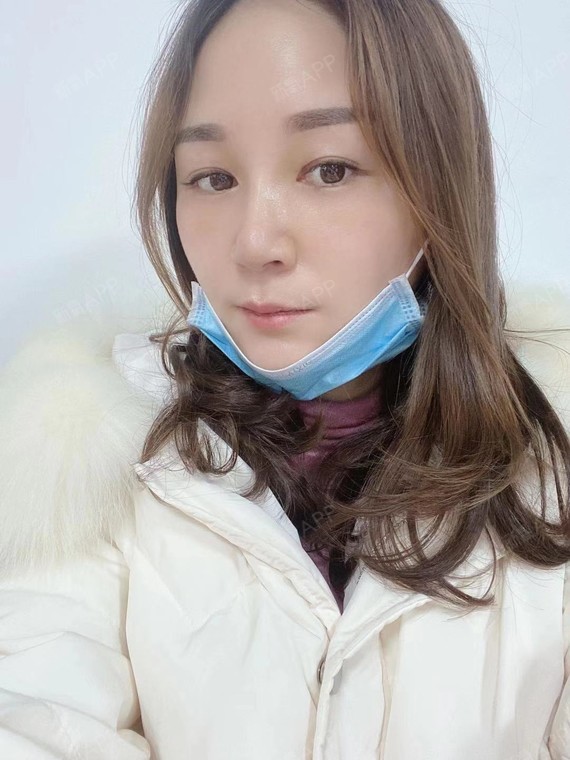 【鼻部多项  线雕术后15】做完鼻子半个月了,鼻子是_圈子-新氧美容