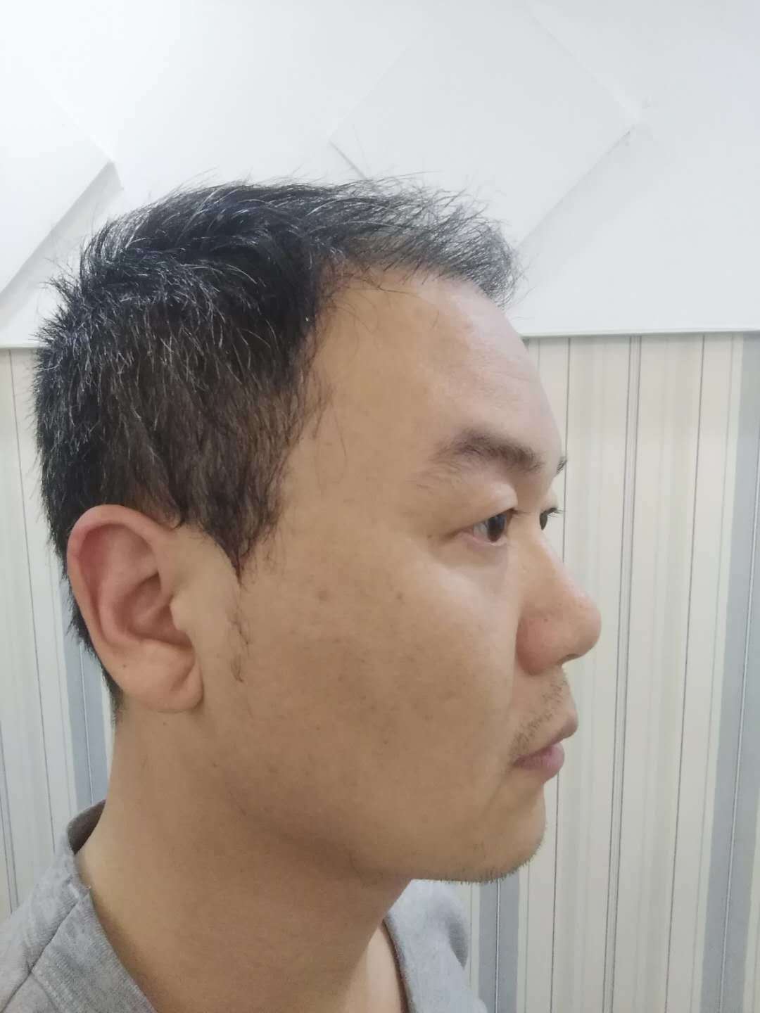 成都丝恒植发李显耀医生怎么样_好不好_挂号_整形案例-新氧整形