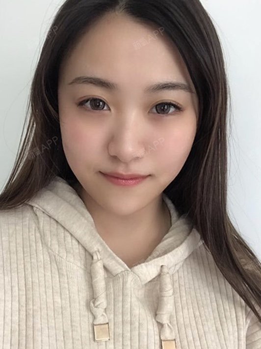 真不敢相信恢复的这么好,皮肤光滑细嫩,显得气色好了_圈子-新氧美容