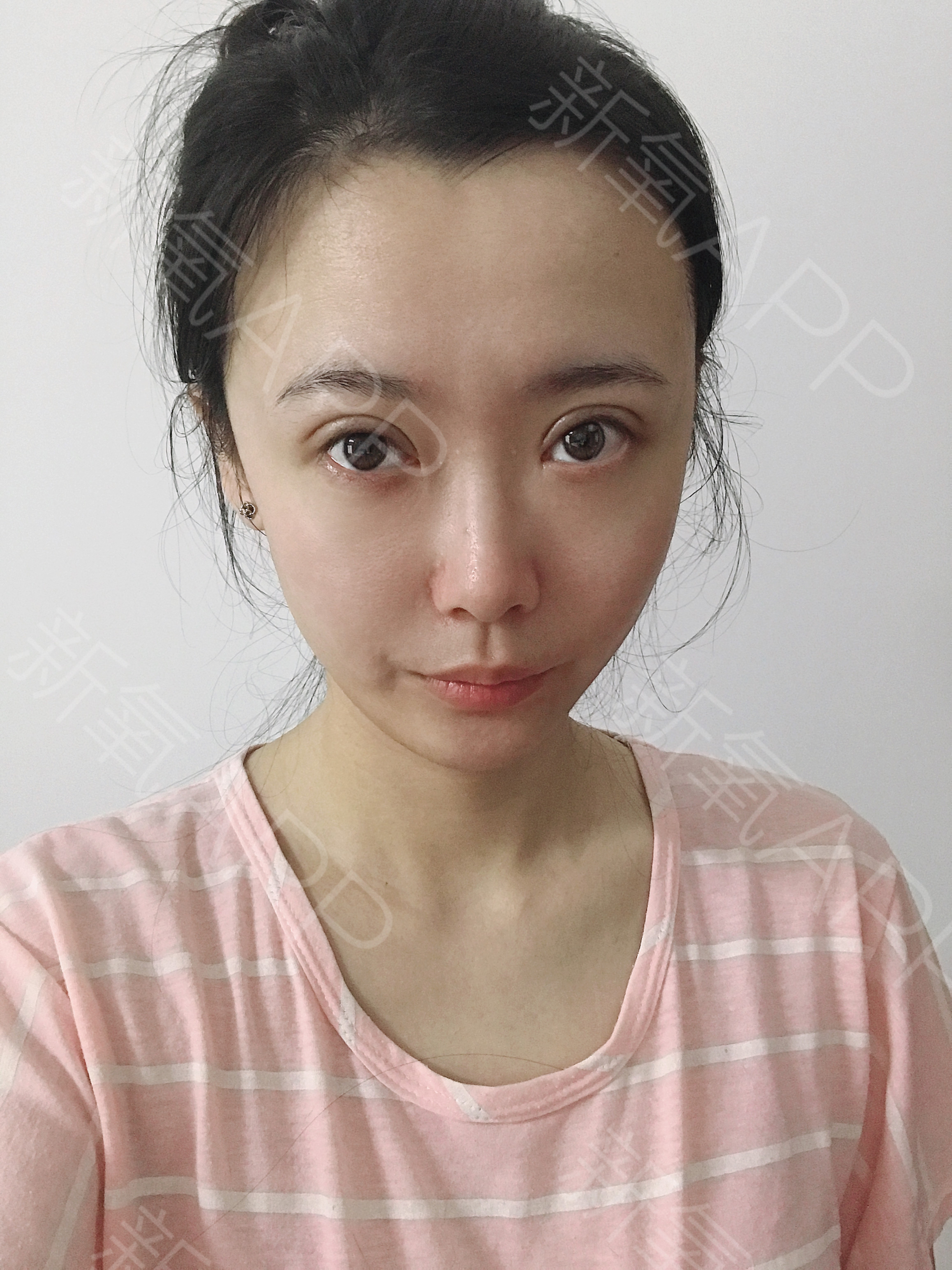 上海華美醫療美容醫院眼部綜合怎麼樣_恢復過程_效果如何_灌籃超高手