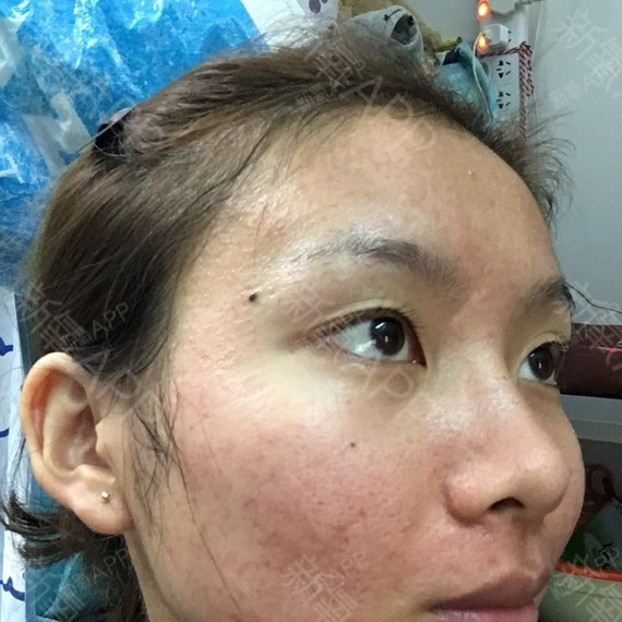 医生和我说做完微针之后面部通常会泛红,表现稍明显一_圈子-新氧美容