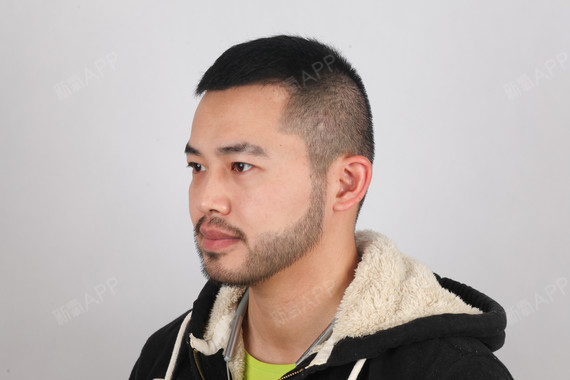 成都种植胡须好不好_效果图_精壮的野猪种植胡须术后第642天_新氧美容