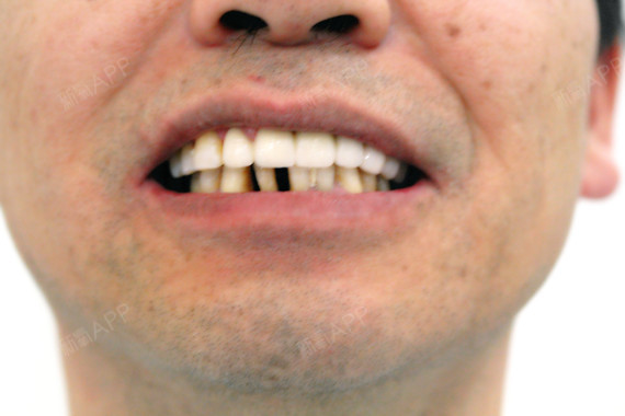 十多年前 全口牙多年开始不齐松动 移位 蛀牙 二十 圈子 新氧美容整形
