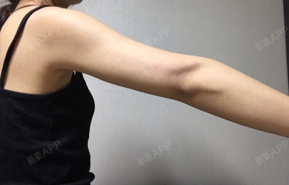 手臂抽脂术后一个月很开心,已经没有淤青了皮肤也很紧_圈子-新氧美容