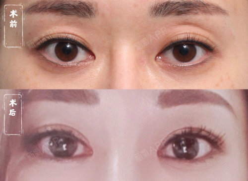 而且双眼变的有神清爽 做全切双眼皮同时填充的 上眼睑凹陷部分 术后