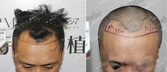  术前m型发际线及发际线种植2500毛囊单位面积图 >
