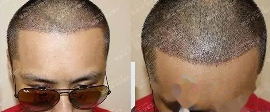  种植2500毛囊单位,第5天的照片>