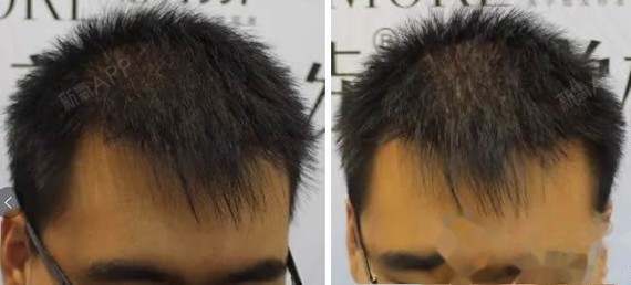 据了解,哈尔滨植发的五级脱发种植4000单位的植发真实案例,具体这家