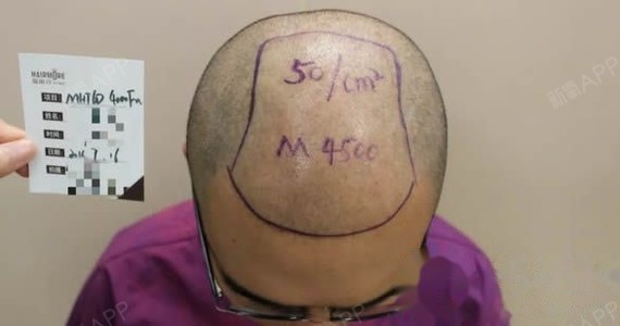 据了解,哈尔滨植发的五级脱发种植4000单位的植发真实案例,具体这家