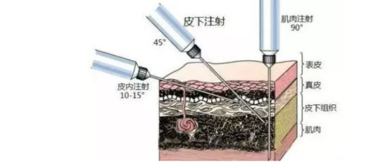 首页 此页面仅支持预览 Avatar 氧气9j5kv 26篇日记 嗨体打完多久见效 经验分享嗨体的副作用该如何护理 嗨 体打完多久见效 我的经验分享给你到底嗨体的副作用应该如何护理 今天小编就来跟大家讲讲嗨体打完以后多久可以见效 做嗨体出现副作用了应该