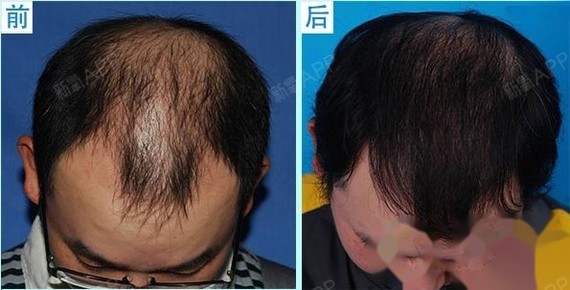 医院植发案例 男性秃顶植发效果对比典型男性脱发:大