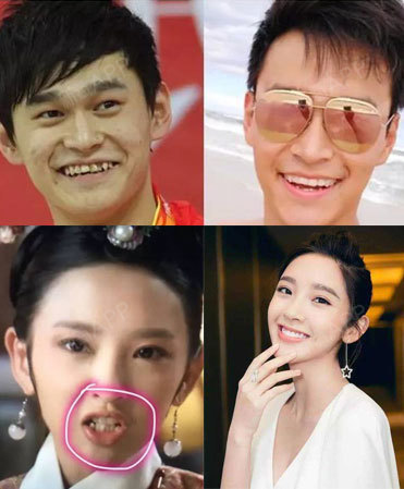 还有早期和现在的照片对比明显的孙杨和唐艺昕也都是做了隐形矫正.